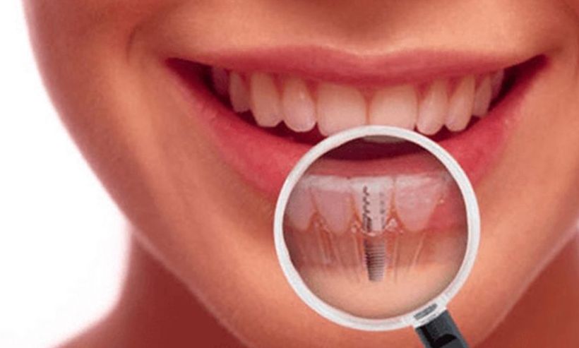 Tot ce trebuie sa stiti despre implanturile dentare